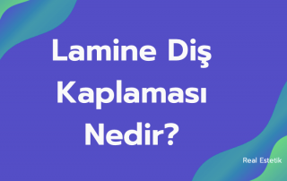 lamina diş kaplaması nedir