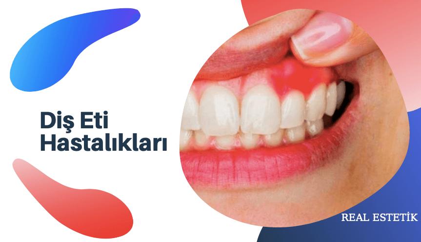 Diş Eti Hastalığı (Periodontoloji) Nedir?