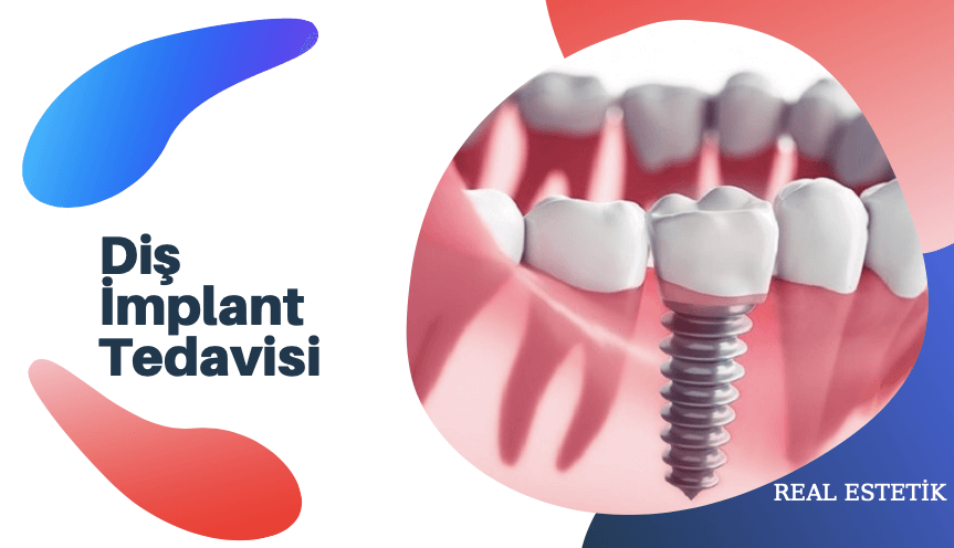 diş implant tedavisi